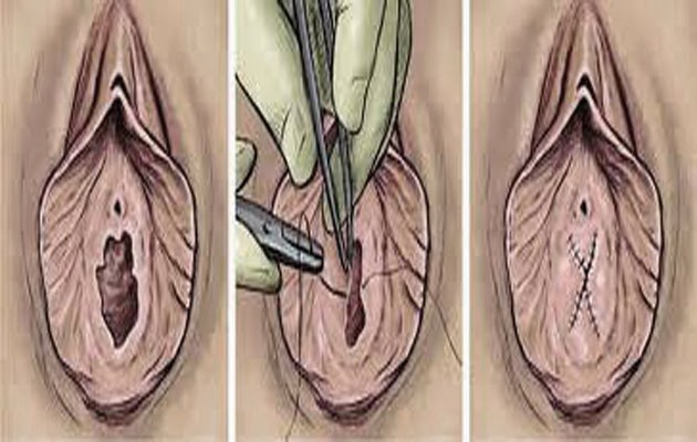 Hymenoplasty Surgery
