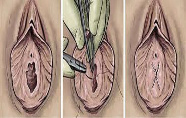 hymen reconstruction